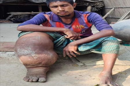 নগরকান্দায় ফাইলেরিয়া রোগে ভুগছেন বোরহান, মানবিক সহায়তার দাবি