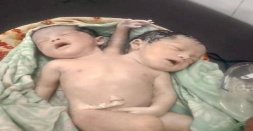 নওগাঁয় দুই মাথা তিন হাতওয়ালা শিশুর জন্ম